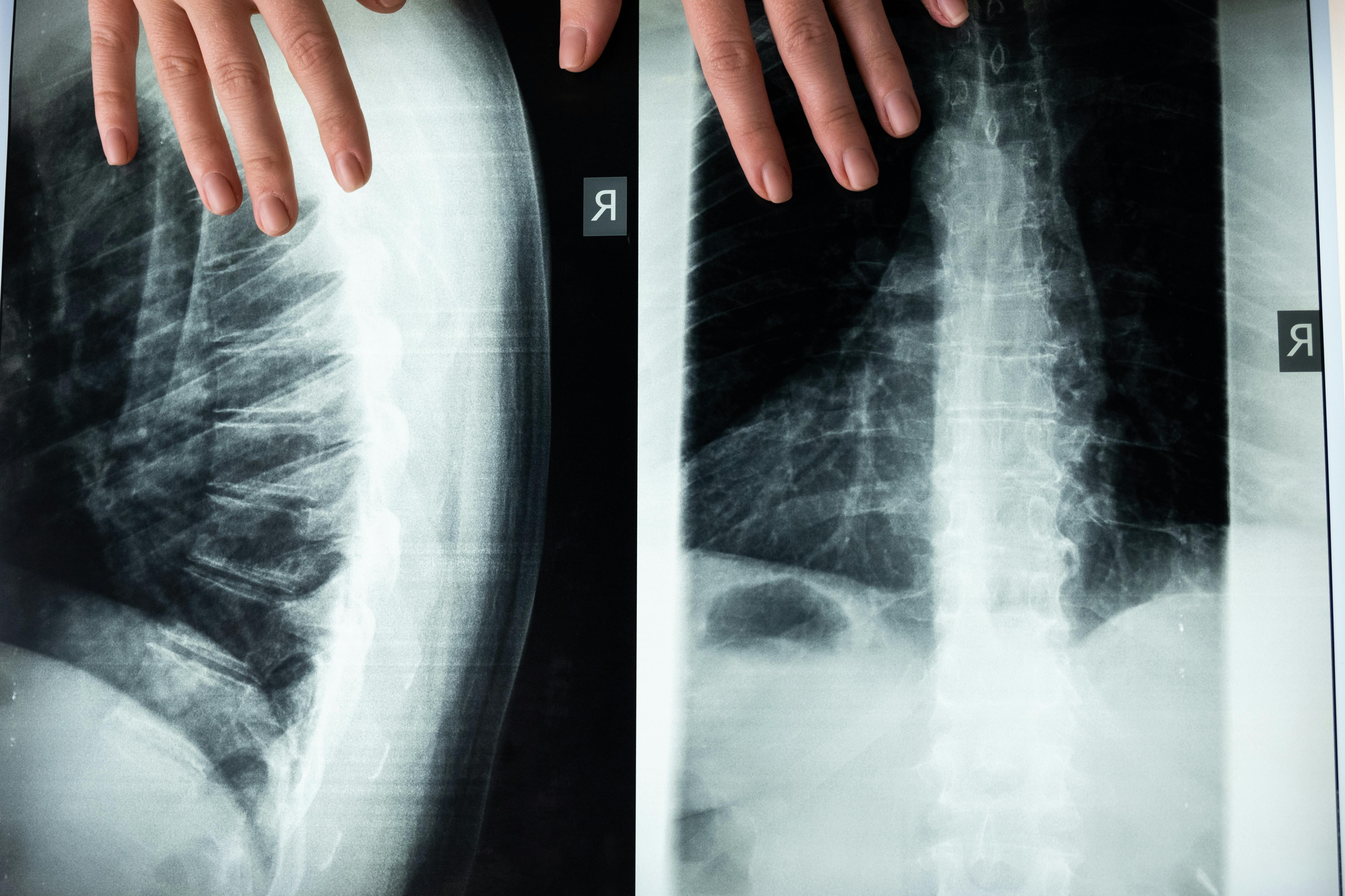 Spine & Back Disorders Pediatric Orthopedic Concerns