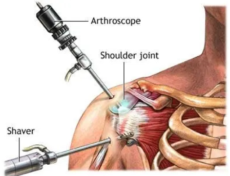 Robotic Shoulder Replacement